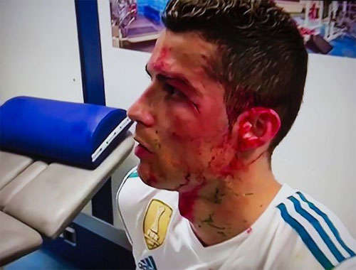 Vết rách gần mắt của Ronaldo
